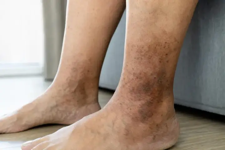 Prurito alle gambe - cause, rimedi e segnali da non ignorare
